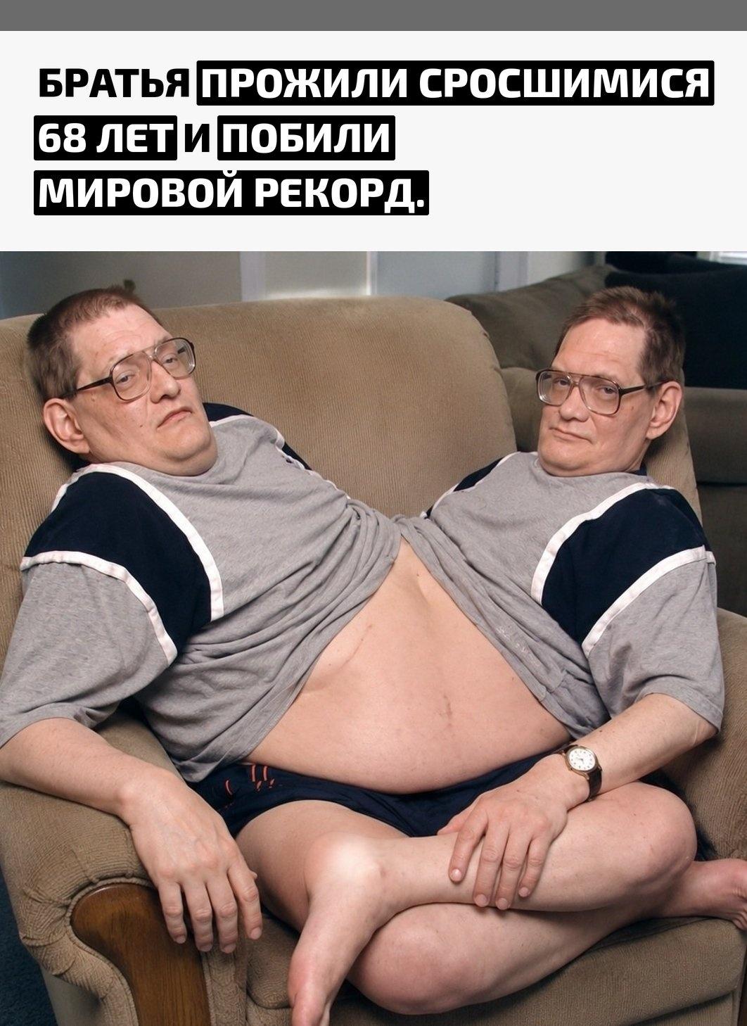 Ронни и Донни Галион родились в Огайо в 1951 году, соединёнными в области живота и таза