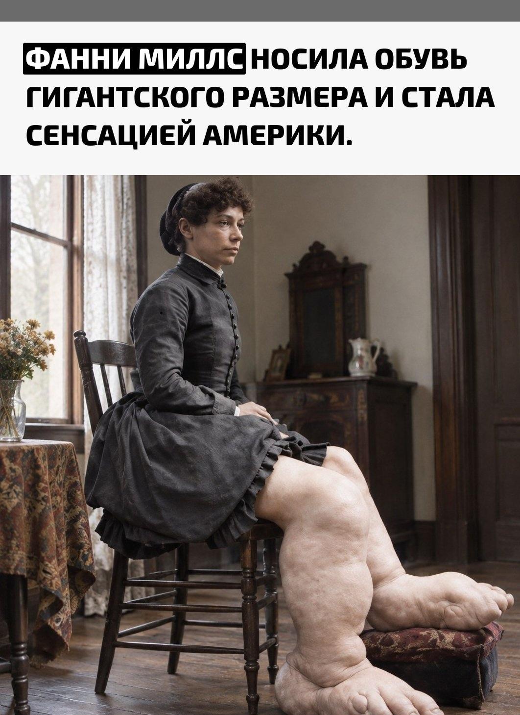 Англичанка Фанни Миллс родилась в 1860 году и ещё ребёнком столкнулась с болезнью Милроя — редким нарушением лимфатической системы. Из-за сильнейших отёков её ноги постепенно увеличивались, а ходить без помощи становилось всё тяжелее.