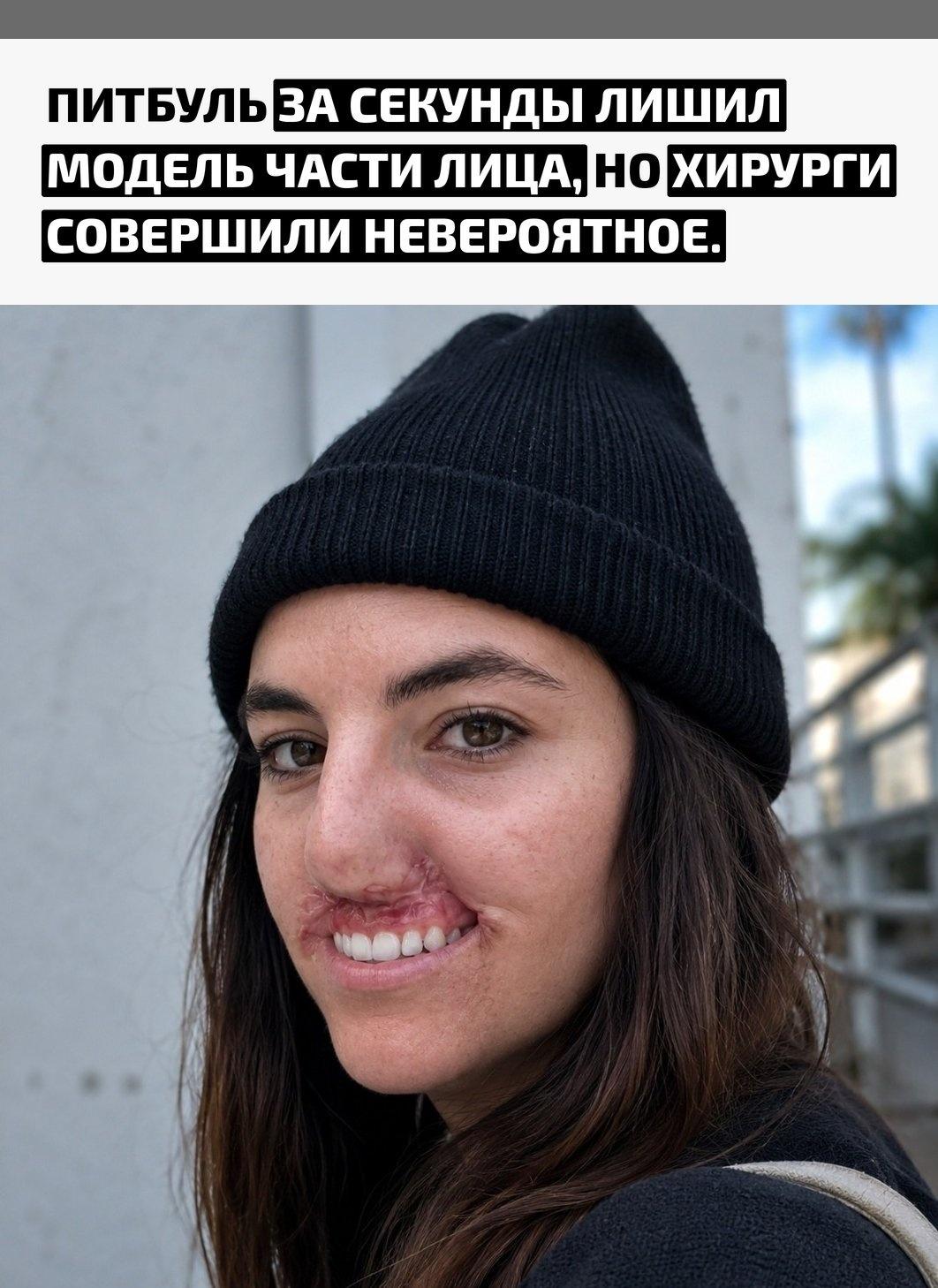 В 2020 году жизнь 23-летней Бруклинн Хури изменилась после нападения питбуля, принадлежавшего ее родственнику. Собаку быстро оттащили, но этого хватило: девушка потеряла верхнюю губу и кончик носа.