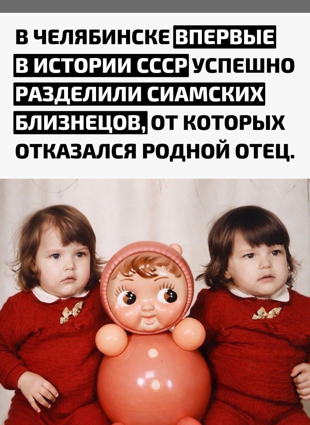 Девочки Аня и Таня Коркины родились 9 апреля 1990 года сросшимися в области живота и имевшими одну печень на двоих