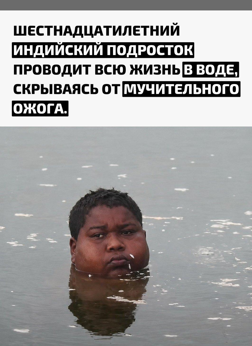Юноша вынужден находиться в местном водоеме по двадцать часов в сутки, так как любое соприкосновение с воздухом вызывает у него нестерпимое жжение кожных покровов