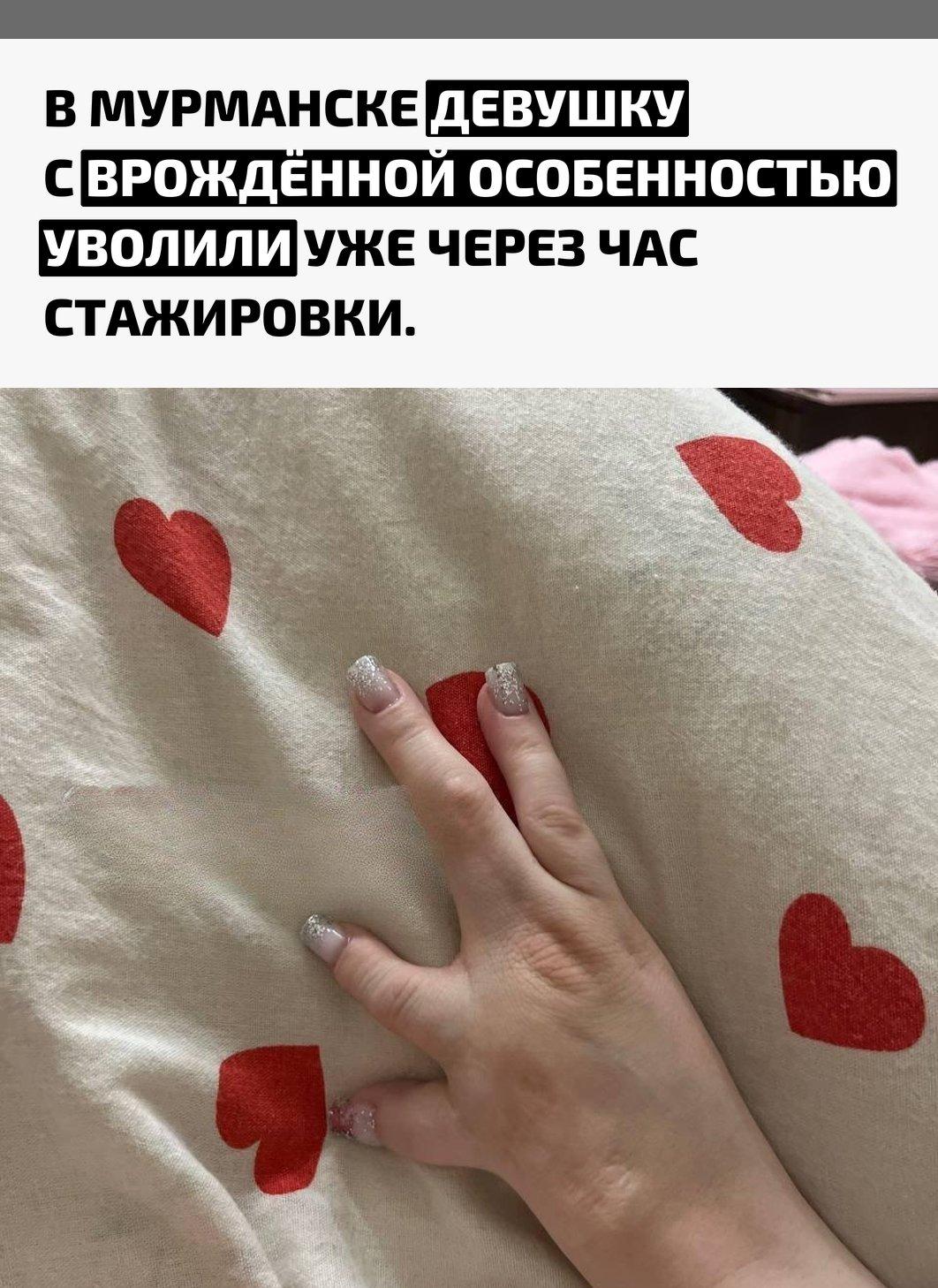 19-летняя Карина пришла на стажировку в ювелирный магазин, но вскоре её вызвала директор. По словам девушки, ей заявили, что о такой особенности внешности нужно было сообщить заранее, после чего попросили уволиться.