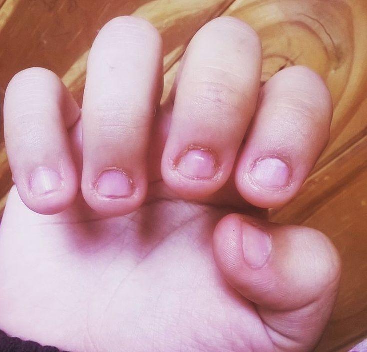 Страшная правда о детях, которые грызут ногти