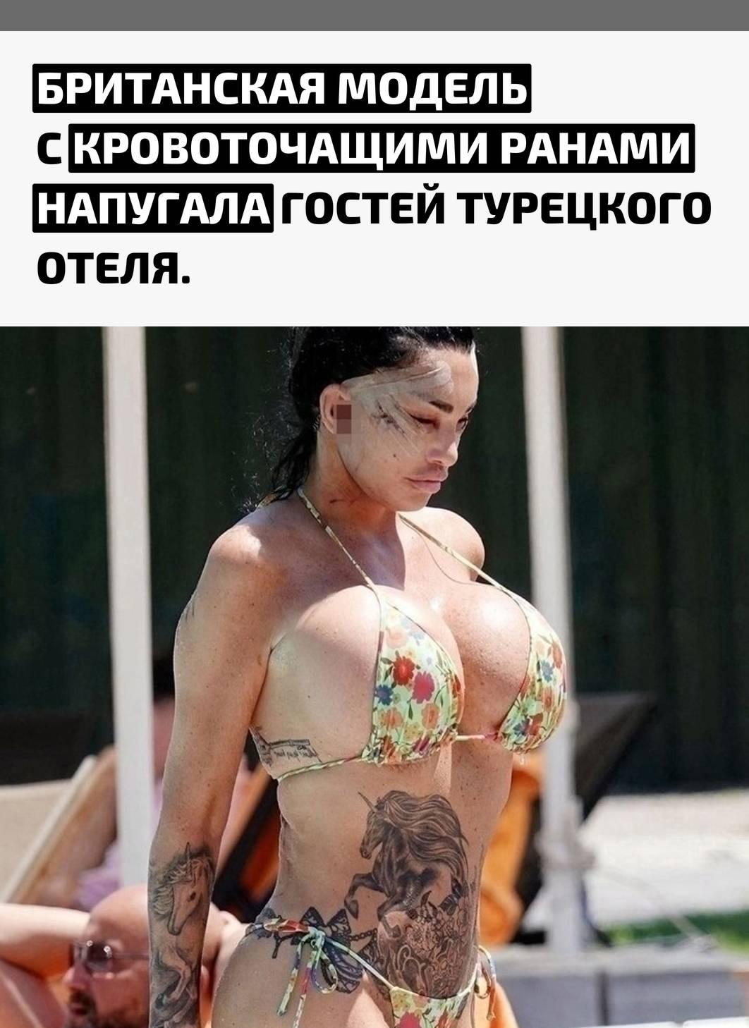 На курорте в отеле Sheraton Ataköy Кэти Прайс вышла к бассейну с гнойными и кровоточащими повреждениями на голове. Отдыхающие оказались шокированы её видом и не смогли продолжить отдых спокойно.